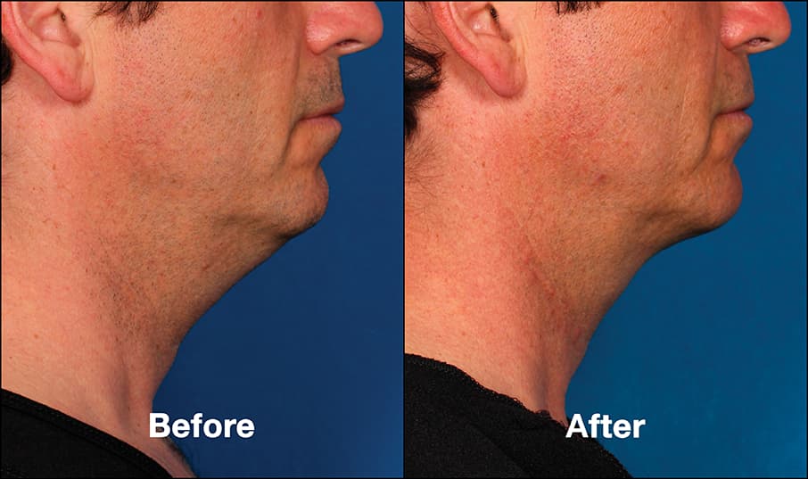 kybella before and after