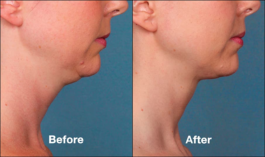 kybella before and after