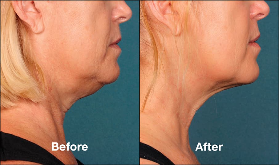 kybella before and after