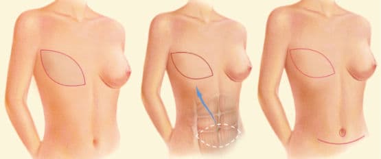 Does Insurance Cover Breast Reconstruction?